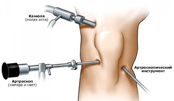 Artroskopie kolenního kloubu