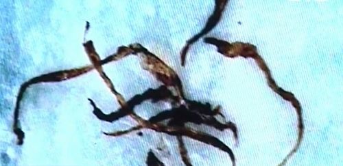 Morgellonova choroba existuje a může souviset s GMO.