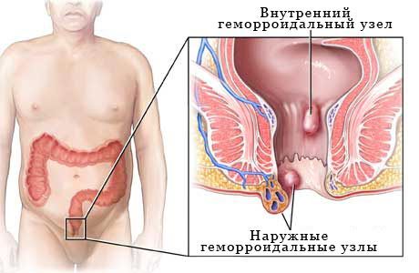 Prevalence hemoroidů