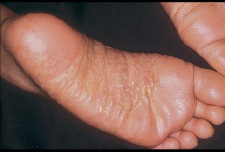 Dermatitida nohou a její příčiny