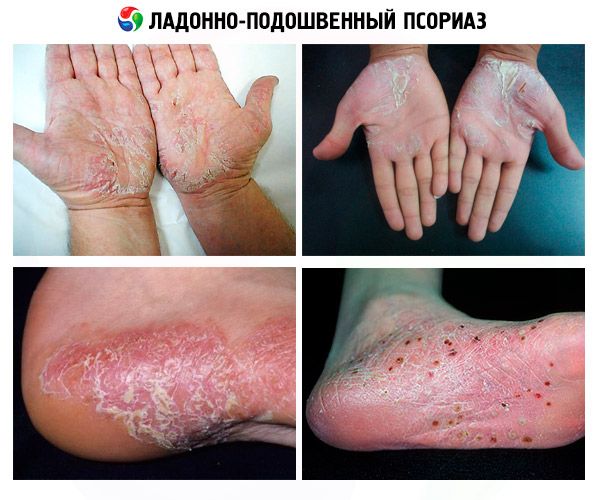 tratamentul mainilor varicoase din makhachkala este posibil sa se vindece vene varicoase cu lipitori