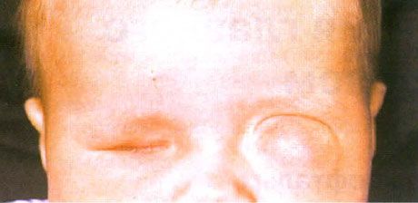 Mikroftalmus s přidruženou tvorbou cyst (levé oko). Anoftalmus (pravé oko).