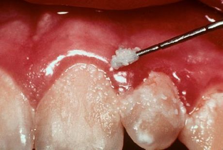 Zuby a zánět dásní