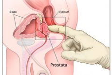 prostatita si hidromasaj
