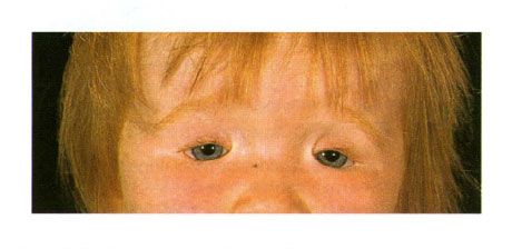 Oboustranný kolobom víček u dítěte s malým syndromem.  Uzavření očního štěrbiny vlevo