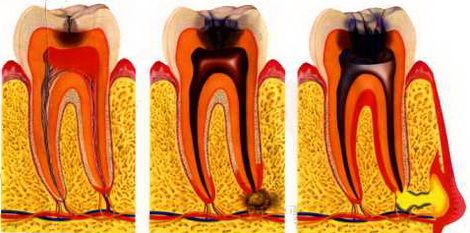 Bolesti zubů po naplnění 